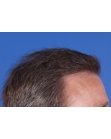 After Hair Transplant&nbsp;Front